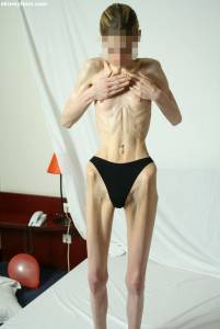 EXTREME Skinny Anorexic Janine 1 t7btsg2poh