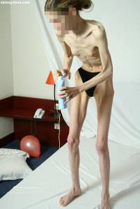 EXTREME Skinny Anorexic Janine 1-g7btsga3oa.jpg