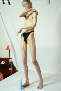 EXTREME Skinny Anorexic Janine 1 u7btsgmbio
