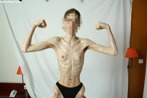 EXTREME Skinny Anorexic Janine 1 o7btsh4iki