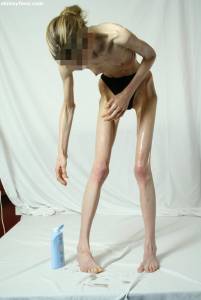 EXTREME Skinny Anorexic Janine 1 l7btsgs4ow