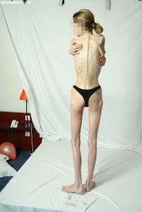 EXTREME Skinny Anorexic Janine 1 q7btshohap