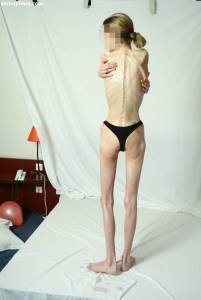 EXTREME Skinny Anorexic Janine 1-q7btshohap.jpg