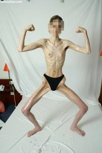 EXTREME Skinny Anorexic Janine 1-07btsh3mth.jpg