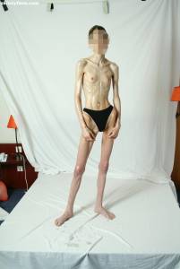 EXTREME Skinny Anorexic Janine 1 u7btshseba