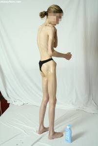 EXTREME-Skinny-Anorexic-Janine-1-p7btshd6lo.jpg