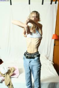 EXTREME-Skinny-Anorexic-Janine-1-d7btsbbj2c.jpg