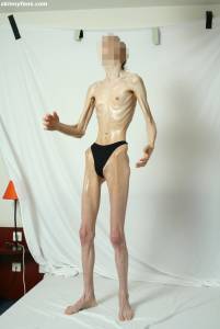 EXTREME Skinny Anorexic Janine 1 l7btsi7ope