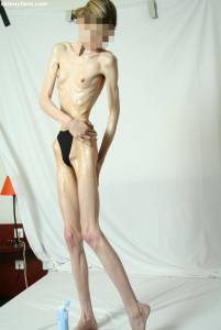 EXTREME Skinny Anorexic Janine 1 b7btsglffz