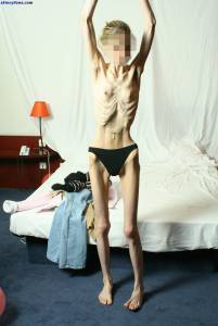 EXTREME Skinny Anorexic Janine 1t7btsbmahr.jpg