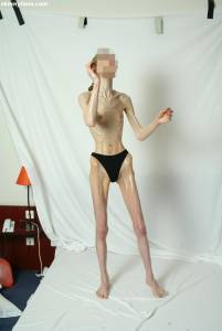 EXTREME Skinny Anorexic Janine 1-i7btsi1z4k.jpg