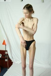 EXTREME Skinny Anorexic Janine 1 y7btsgefic