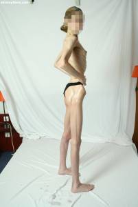 EXTREME-Skinny-Anorexic-Janine-1-b7btsh9ij1.jpg