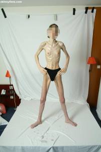 EXTREME Skinny Anorexic Janine 1 n7btsh7w5a