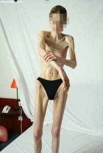 EXTREME Skinny Anorexic Janine 1 p7btsg44et