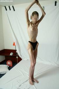 EXTREME-Skinny-Anorexic-Janine-1-b7btsh0cgm.jpg