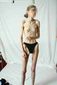 EXTREME Skinny Anorexic Janine 1 h7btsfvsqd