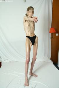 EXTREME Skinny Anorexic Janine 1 a7btshtugo