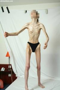 EXTREME-Skinny-Anorexic-Janine-1-t7btsi57r5.jpg