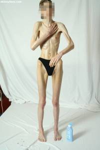 EXTREME Skinny Anorexic Janine 1 s7btshepej