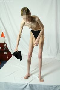 EXTREME Skinny Anorexic Janine 1 s7btsfrnus