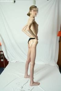 EXTREME-Skinny-Anorexic-Janine-1-d7btsh87wx.jpg