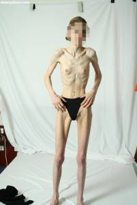 EXTREME Skinny Anorexic Janine 1 x7btsfse21