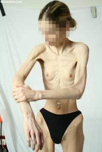 EXTREME Skinny Anorexic Janine 1 p7btsgfeak
